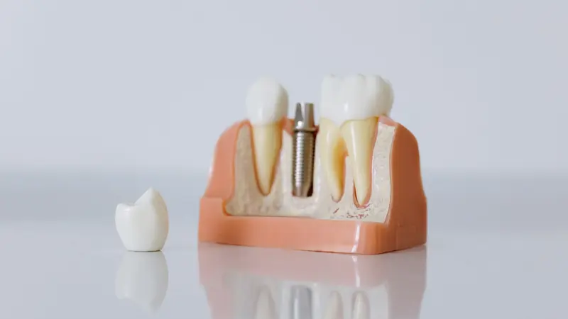 Maquette d'implant dentaire avec sa vis et sa couronne